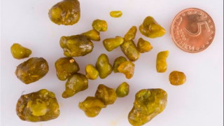 Дядо Иван от Чавдар: Сто камъка от жлъчката изхвърлих с този илач! На цяло село го дадох (помага и при увеличен черен дроб)