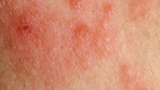 Не пренебрегвайте тези 4 симптома: Издават рак на кожата