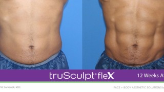 Топене на мазнини без скалпел? Клиентите на Derma-Act ваят тела с лазер, топлина, радиочестота, инжекции и криолиполиза