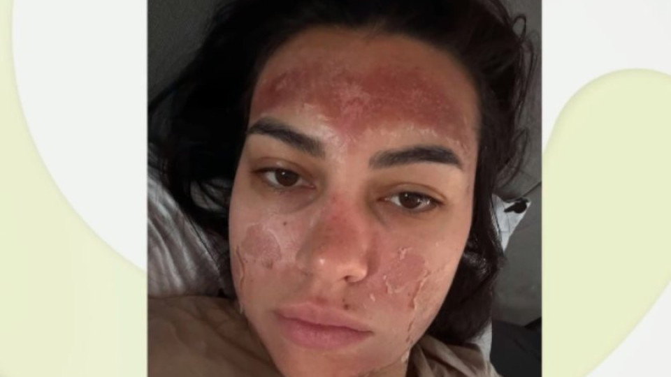 Козметичка обезобрази млада жена с пилинг